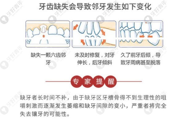 长期缺牙临牙发生的变化如下