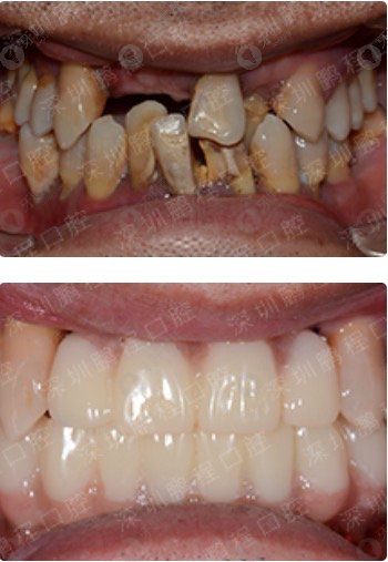 深圳鹏程口腔种植牙对比案例.png