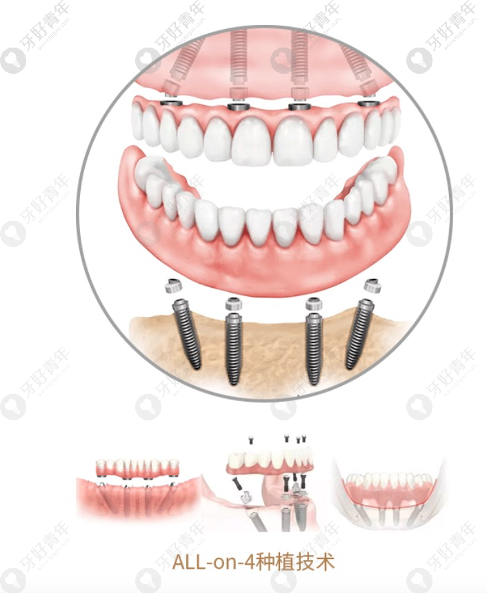 All-on-4种植牙技术.png