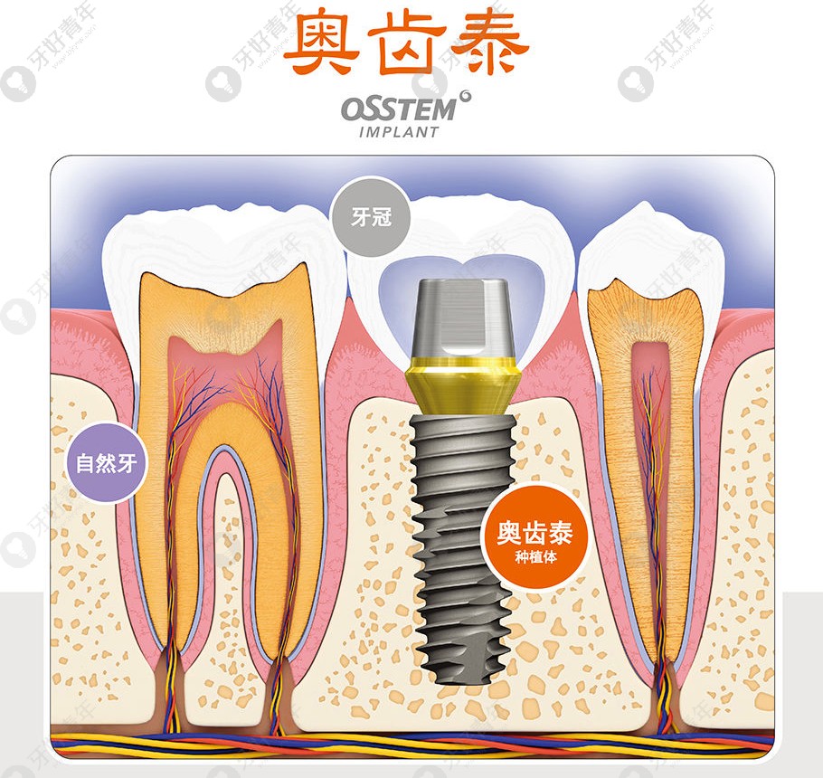 100-1fr5153aa39.jpg 韩国奥齿泰（OSSTEM)种植系统.jpg