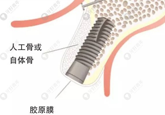 易继恩医生简述关于种植牙植骨的相关科普