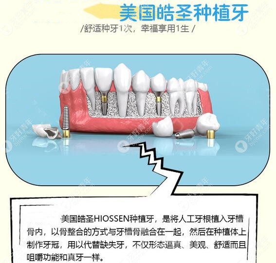 广州圣贝口腔美国皓圣种植牙优势