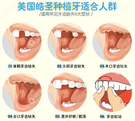 广州圣贝口腔美国皓圣种植牙适应症