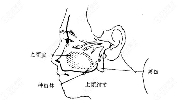 武汉大众口腔穿翼板种植术.png