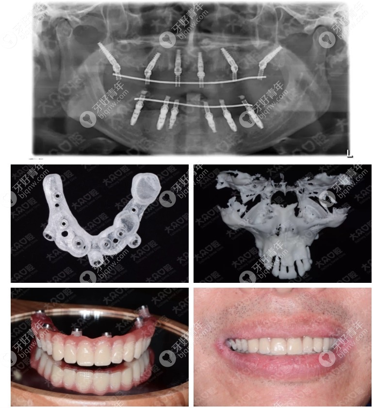武汉大众口腔种植案例.png