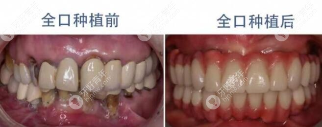 我在北京佳美口腔做全口种植牙的口内照片