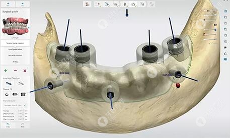 昆明美奥口腔种植牙3D导板