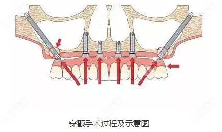 穿翼手术过程及示意图