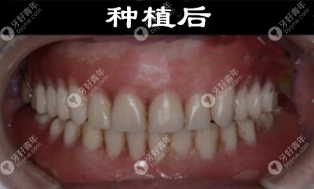 成都新桥口腔全口种植牙案例
