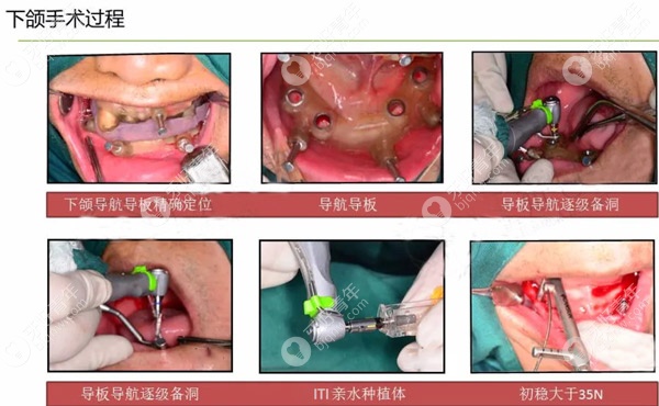 下颌种植牙手术过程
