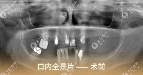 全口种植牙前的CT片
