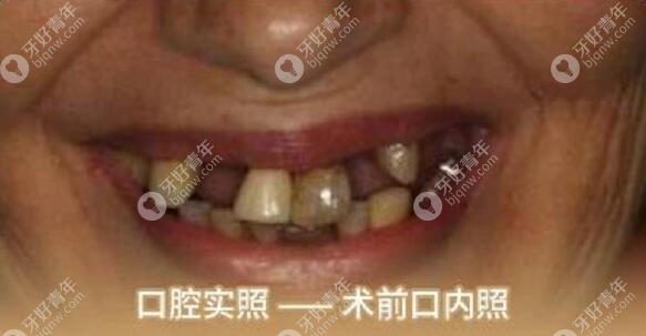 在武汉五洲麦芽口腔做全口种植牙前的照片