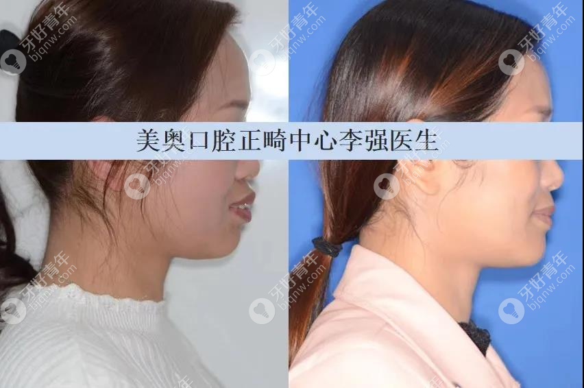 李强院长二次矫正案例