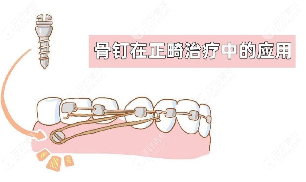 牙齿矫正的打骨钉是什么,说说打支抗钉的作用