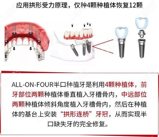 贵阳德韩口腔allon4全口种植牙技术