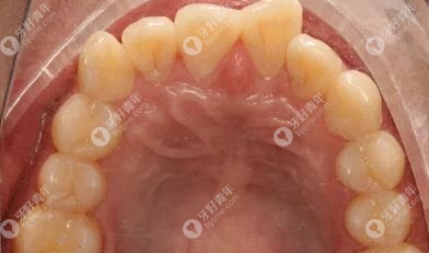 牙列中度拥挤+前突的牙齿