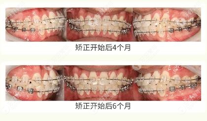 矫正4个月和6个月的牙齿改善情况
