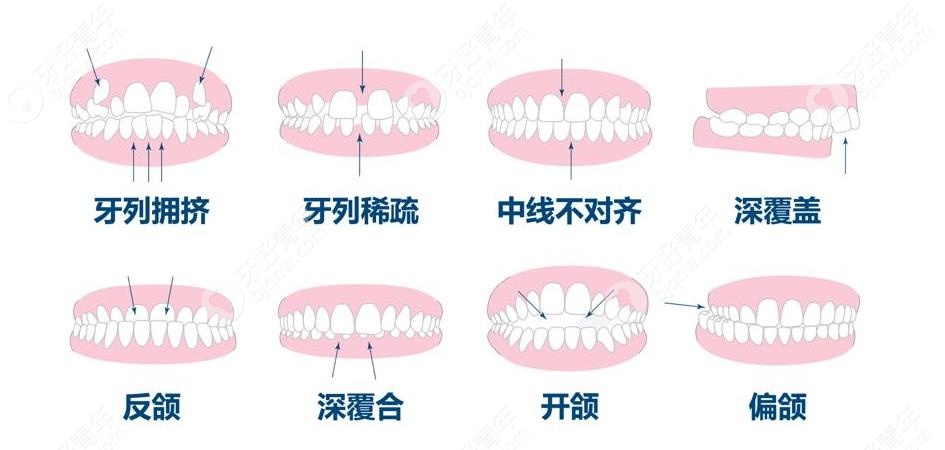 牙齿畸形的症状有哪些？