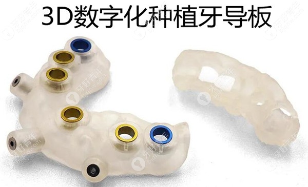 3D数字化种植牙导板