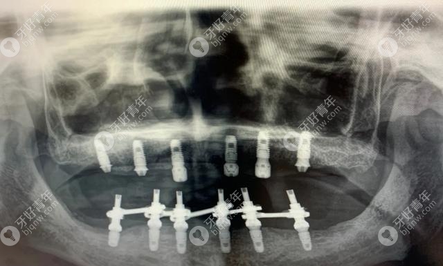 全口allon6种植牙后的CT片