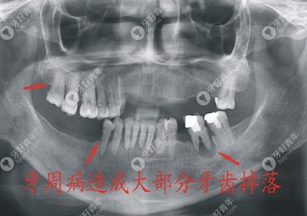 牙周病做种植牙前