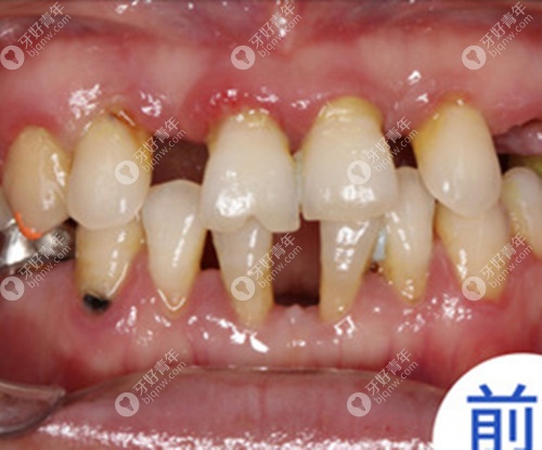 种牙前牙齿情况