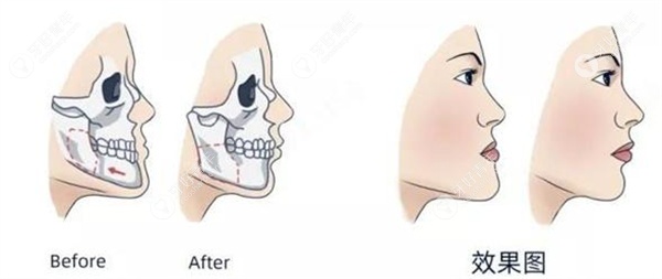 正颌手术是整容吗