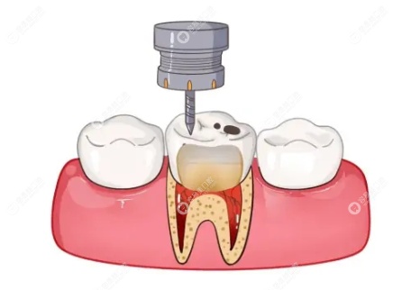【牙齿根管治疗全过程】-根管治疗的具体流程步骤