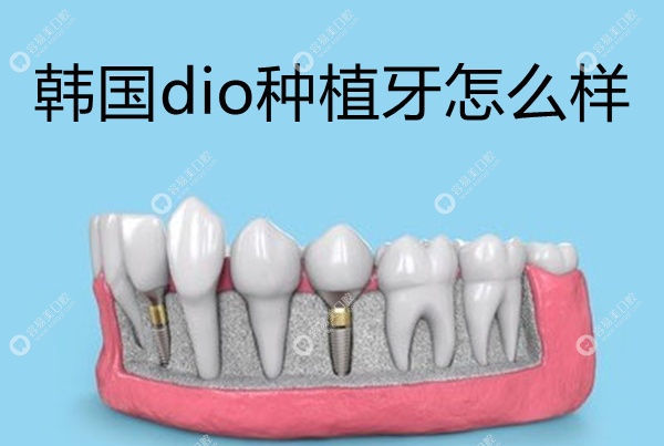 韩国dio种植牙怎么样